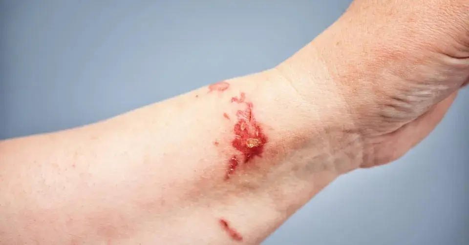 Fotosenzitivní alergická reakce na třemdavu